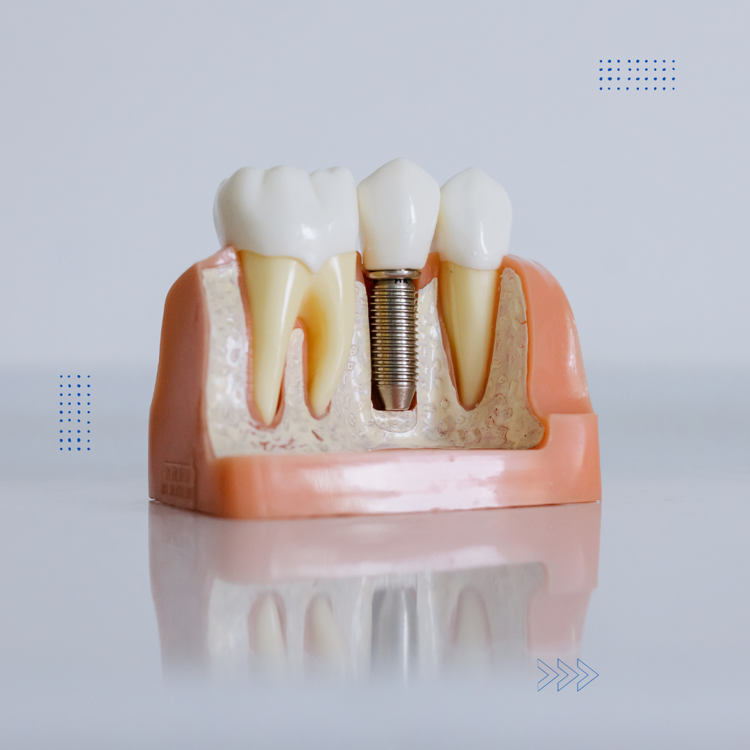 implants